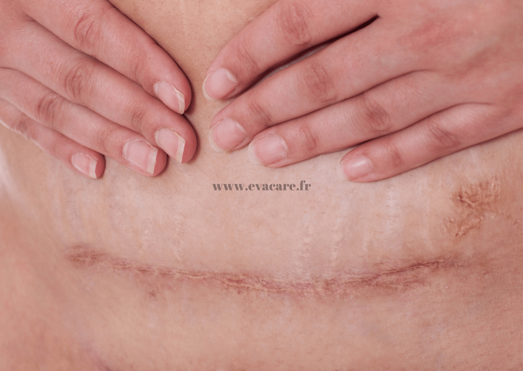 Combien De Temps Pour Qu Une Cicatrice Blanchisse Le tatouage camouflage des vergetures, cicatrices, cernes et tâches