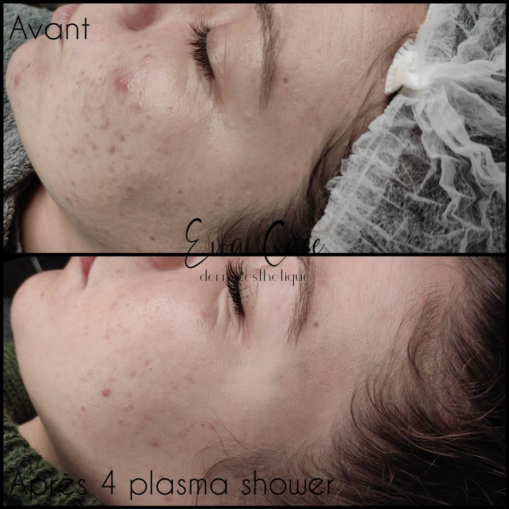 plasma shower acne