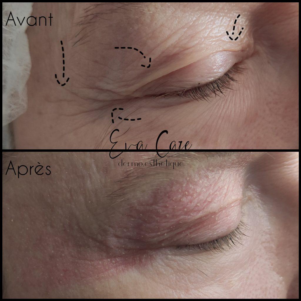 Plasma lift