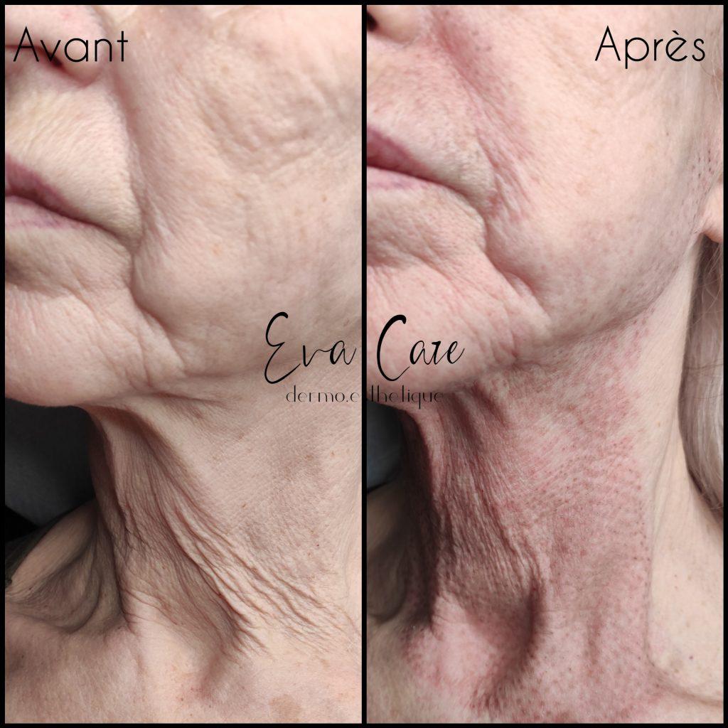 Plasma lift cou