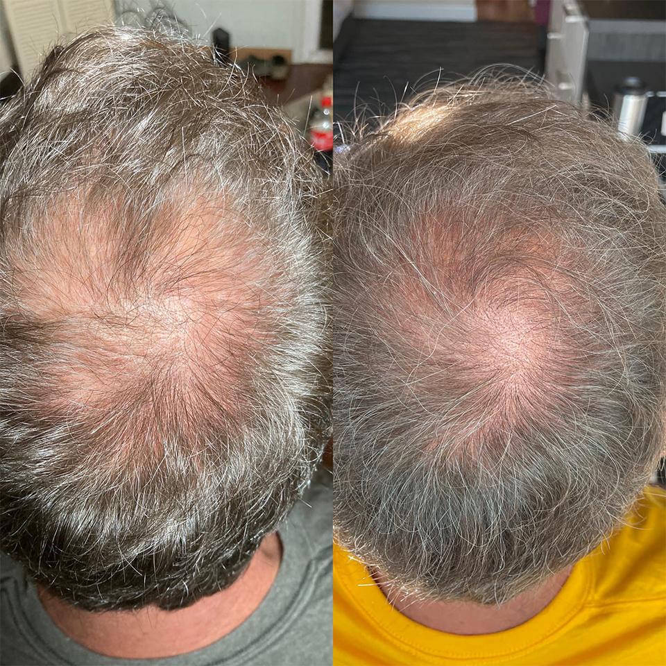 jet-plasma-hair-loss-8-treatments