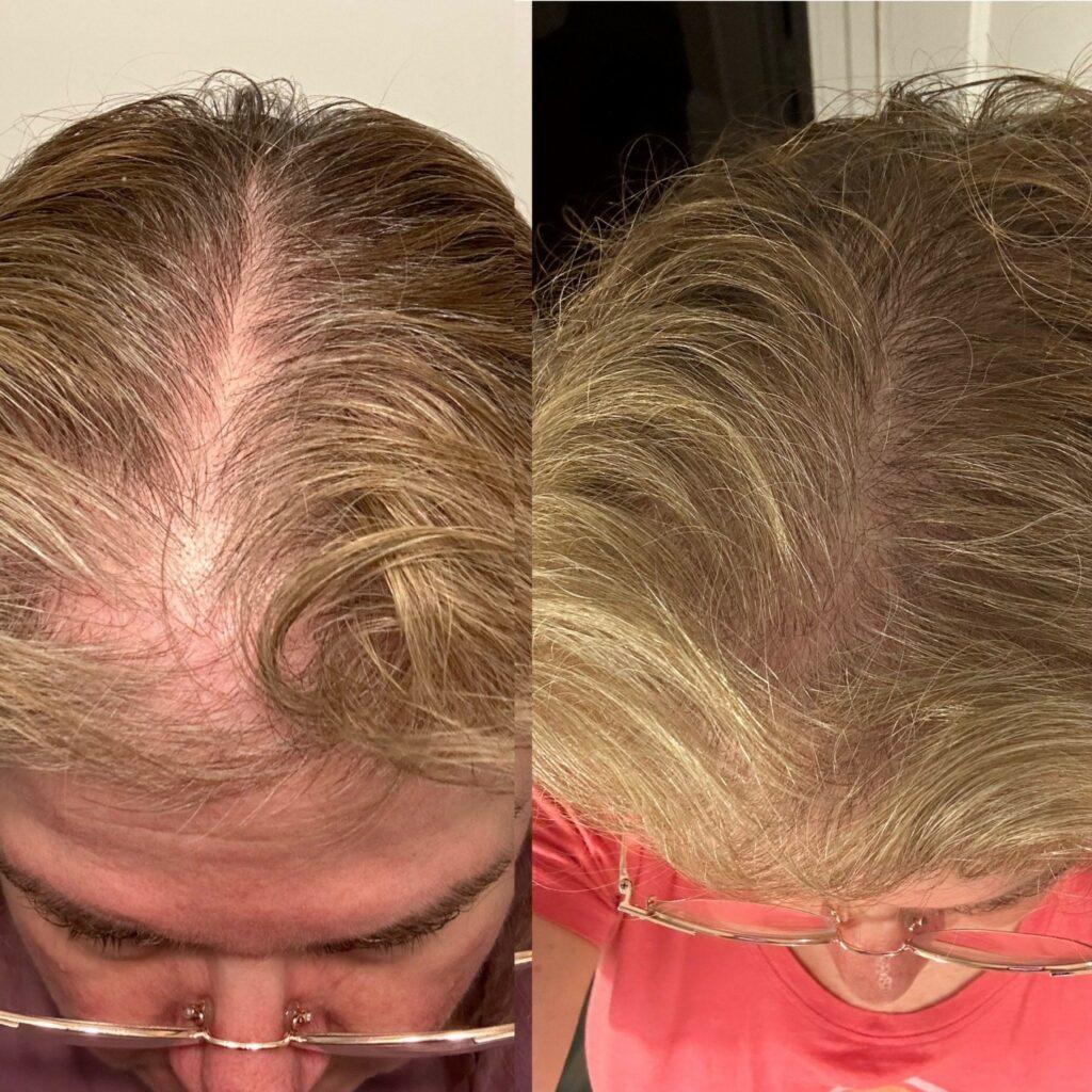 jet-plasma-hair-restoration